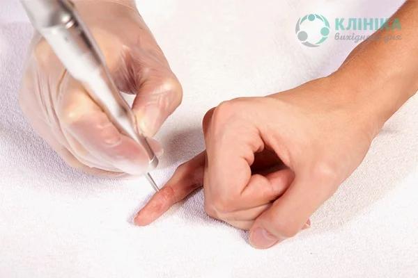 Как избавиться от сухих бородавок