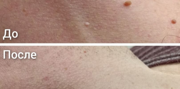 Как удалить папилломы медом?