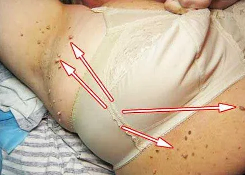 Папилломы под грудью во время беременности