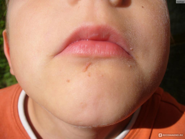 Бородавка на подбородке у ребенка