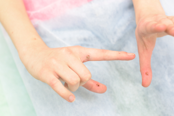 Вирусные бородавки на руках: причины и лечение