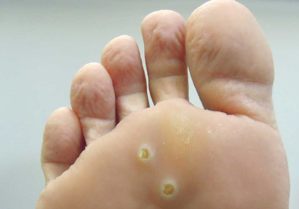 Как вылечить вульгарные папилломы?