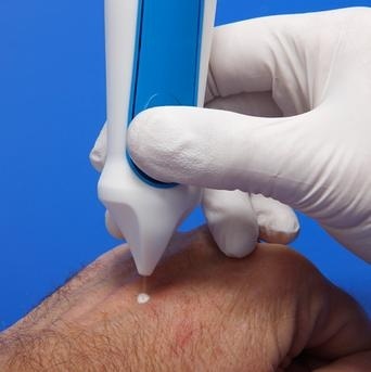 Прижигание папиллом жидким азотом: последствия и отзывы