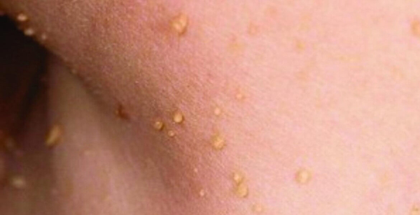 Папилломы на шее при беременности: причины и лечение