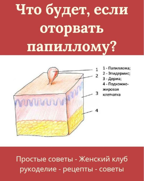 Возможные последствия, если оторвать папиллому на шее