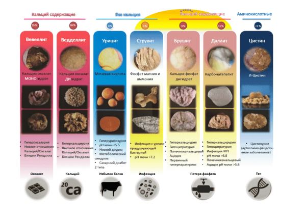Оксалатурия: причины, симптомы, лечение, диета