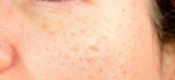 Опасны ли бородавки на лбу и как их удалить