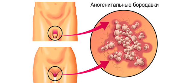Что такое анальная бородавка и как ее лечить