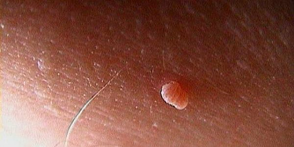 Как избавиться от висячих бородавок под мышкой