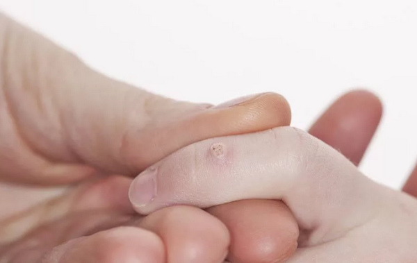 Почему бородавка чернеет: основные причины