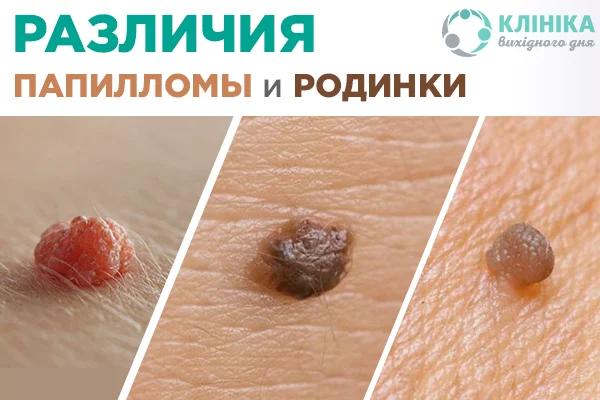 Как избавиться от папиллом под грудью?