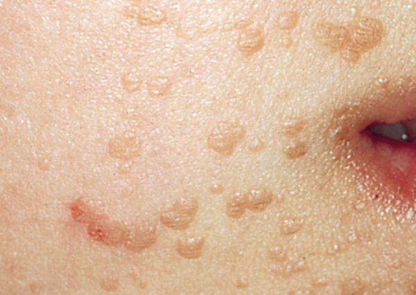 Папилломы на теле у ребенка: симптомы и лечение