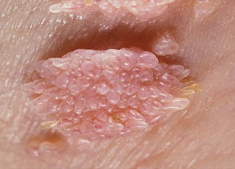 Вирус папилломы человека 66 типа: причины и лечение