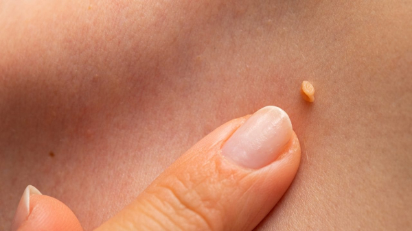 Какие бывают папилломы на теле?