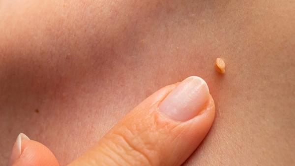 Виды папиллом: их цвета, на каких местах появляются