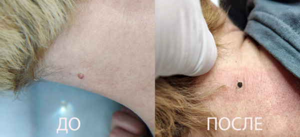 Уход после электрокоагуляции папиллом: основные рекомендации