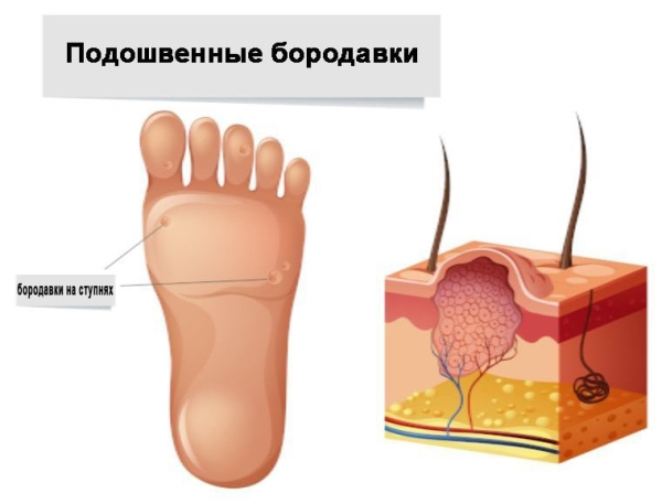 Как избавиться от куриной бородавки на ноге