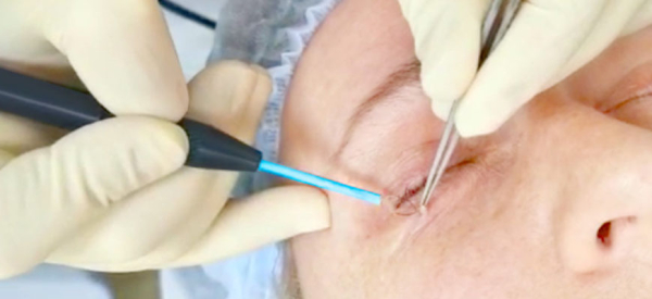 Как убрать висячие бородавки на шее эффективно и безопасно