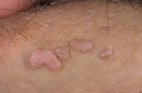 Бородавки на мошонке: причины и лечение