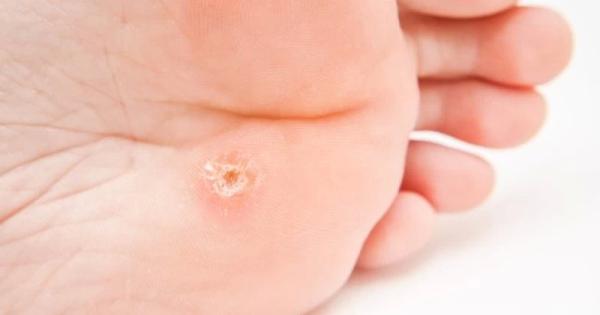 Лечение бородавок на стопе в домашних условиях народными средствами
