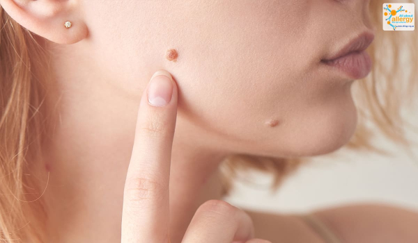 Почему чешутся бородавки на руках: основные причины