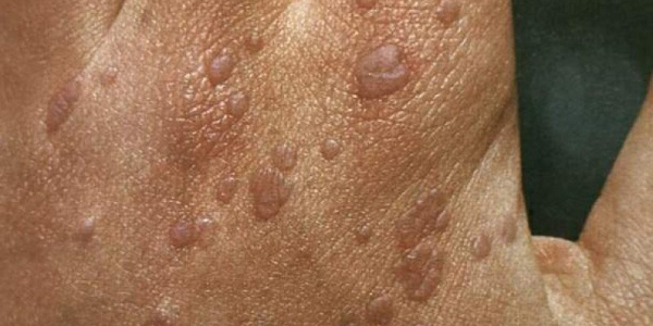 Плоские папилломы: симптомы, причины, лечение и профилактика