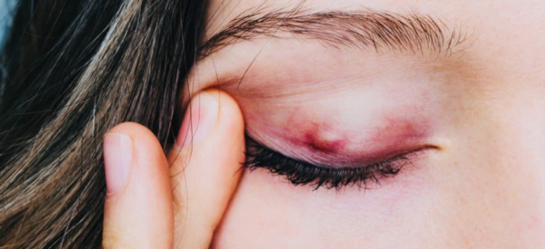 Лечение бородавок на веке глаза народными средствами