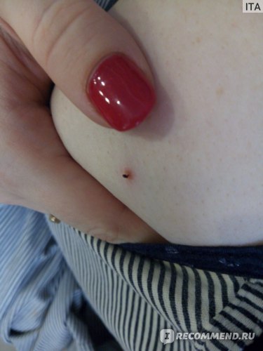 Прижигание папиллом йодом: эффективность и возможные риски