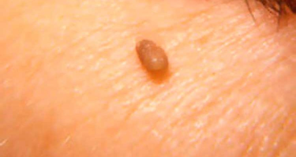 Коричневые папилломы: что это значит и как их лечить