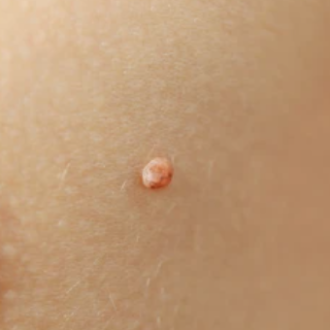 Папилломы на теле во время беременности: что это значит и как лечить