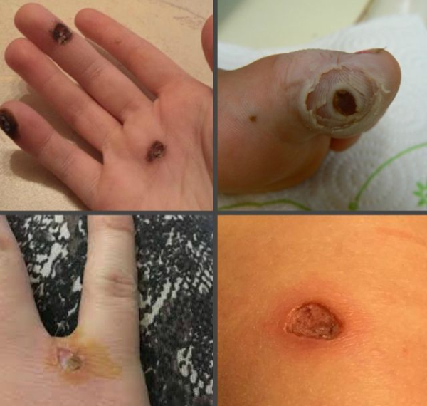 После удаления болит место удаления бородавки: что делать?