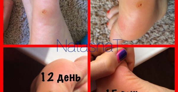 Как вывести бородавки на руках с помощью чистотела