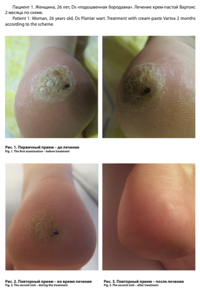Бородавка на ноге при беременности