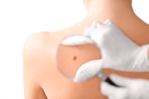 Какая методика лучше: лазерное удаление или электрокоагуляция папиллом?