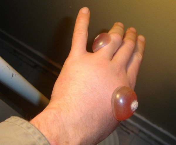 Что делать, если лопнул пузырь от бородавки