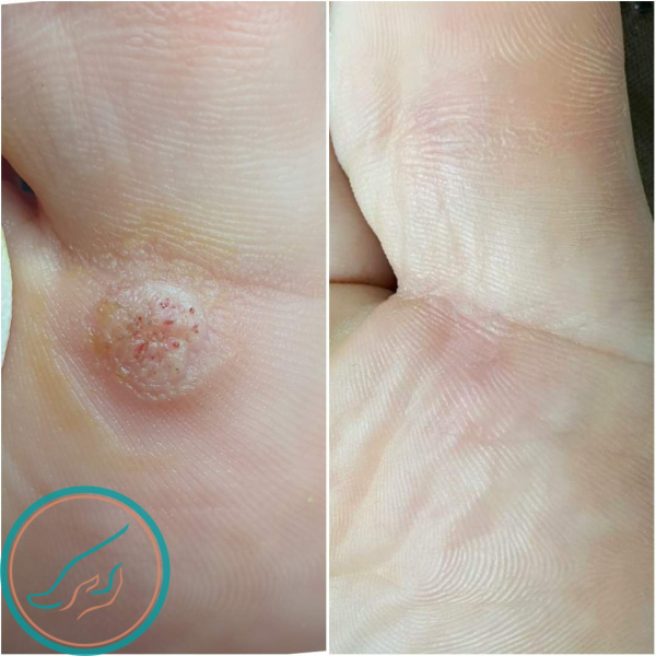 От чего появляются бородавки: основные причины и симптомы