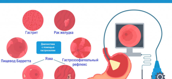 Атрофический гастрит: причины, симптомы, лечение