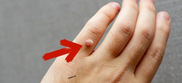 Лук с уксусом от бородавок: рецепты приготовления и отзывы