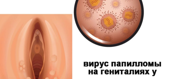 Каким специалистом заниматься при папилломах в интимной области?