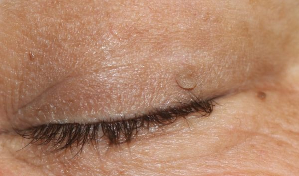 Папилломы на глазах: причины, симптомы и лечение