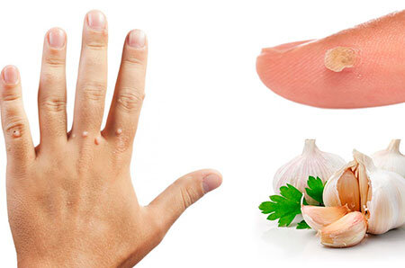 Как избавиться от бородавок с помощью чеснока