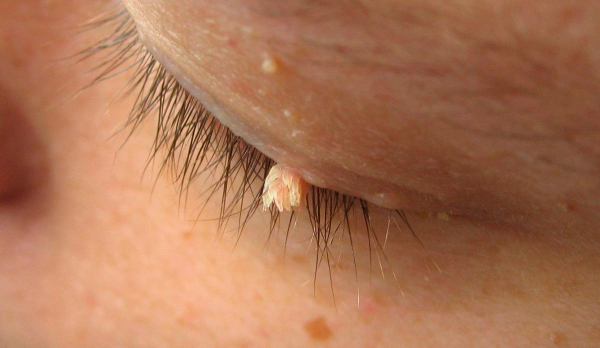 Эффективные методы удаления папиллом с использованием лука