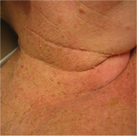 Папилломы после родов: причины и лечение