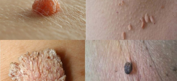 Лазерное удаление папиллом