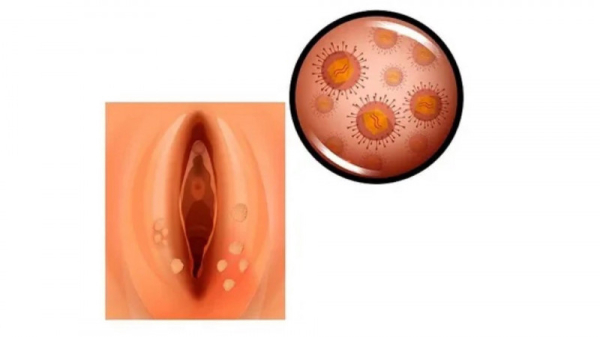 Папилломы на половых губах при беременности: симптомы и лечение