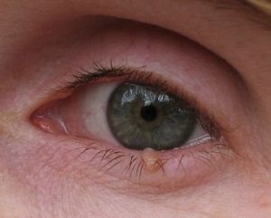 Папиллома верхнего века: причины и лечение