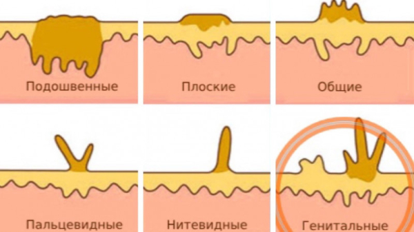 Каким специалистом заниматься при папилломах в интимной области?