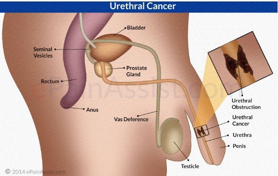 Папиллома в уретре: причины, симптомы, лечение
