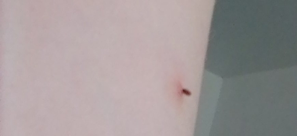 Что делать, если почернела папиллома?