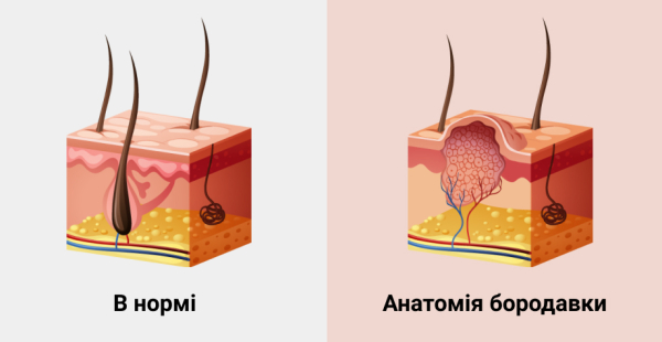 Бородавки в ухе у человека: фото, признаки, лечение